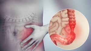 The best treatment for the colon